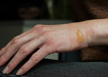 Aumento de casos de esporotricose no Amazonas, revela FVS Imagem ilustrativa (Foto: Reprodução/Canva)