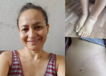 Vakinha: Paciente com câncer de pele agressivo pede ajuda para comprar remédios